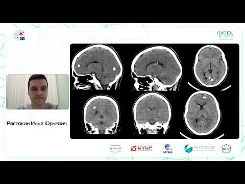 Видео: Туберозный склероз. Растокин И.Ю.