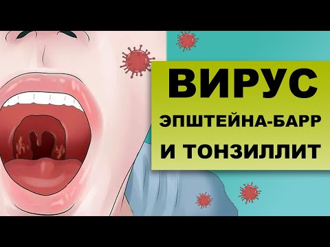 Видео: ХРОНИЧЕСКИЙ ТОНЗИЛЛИТ И ВИРУС ЭПШТЕЙНА-БАРР