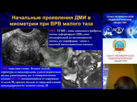Видео: Л.Е.Шарова Дифференциальная диагностика варикозной болезни вен малого таза