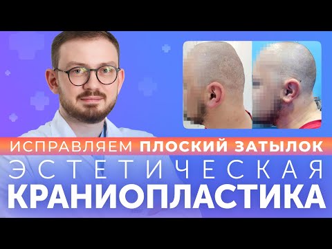 Видео: КРАНИОПЛАСТИКА. Исправляем плоский затылок или покатый лоб.