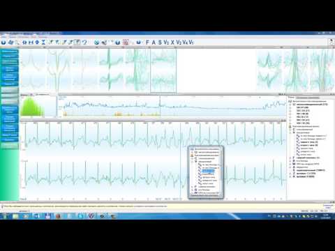 Видео: Result3. Разбор морфологии QRS, страница «Оценка морфологии QRS-комплексов».