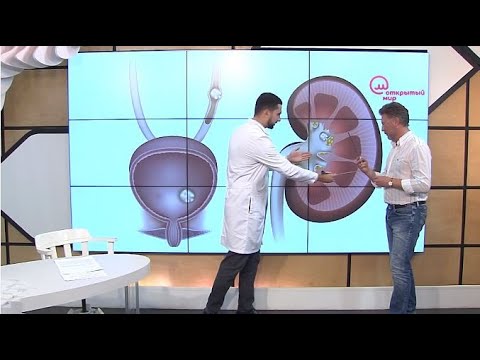 Видео: Доктор знает! Камни в почках | Телеканал "Открытый мир. Здоровье"