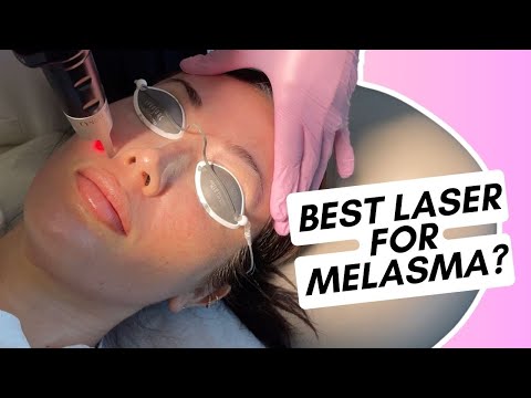 Видео: Является ли Picosure лучшим лазером для лечения мелазмы?