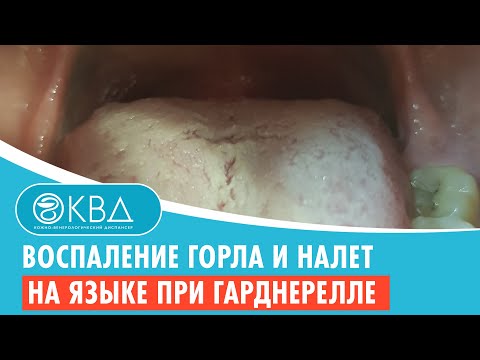 Видео: 👅 Воспаление горла и налет на языке при гарднерелле. Клинический случай №928