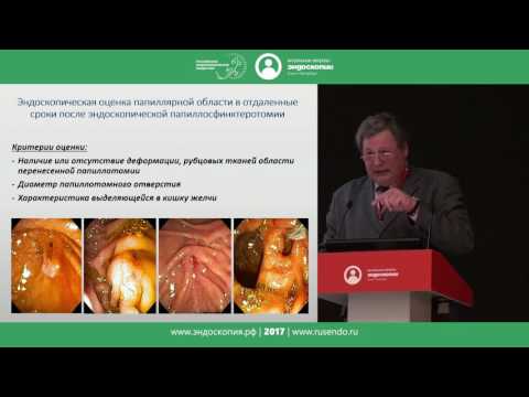 Видео: Клинико-эндоскопическая оценка больных после эндоскопической папиллосфинктеротомии