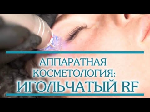 Видео: Процедура – игольчатый RF