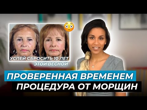 Видео: Альтернатива лазерному омоложению: трихлоруксусный пилинг // Как избавиться от морщин и постакне