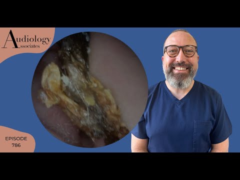 Видео: Удаление ушной серы на глубине 6 см/2,5 дюйма, удаление сухой, крошащейся ушной серы и избытка ко...