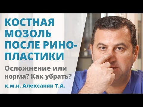 Видео: Костная мозоль после ринопластики: осложнение или норма?