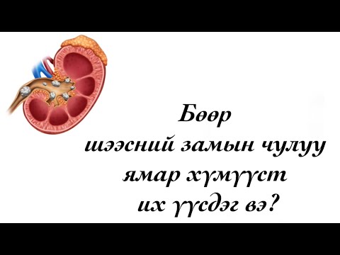 Видео: Бөөр шээсний замын чулуу юунаас болж үүсдэг вэ? 