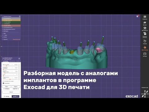 Видео: Разборная модель с аналогами имплантов в программе Exocad для 3D печати