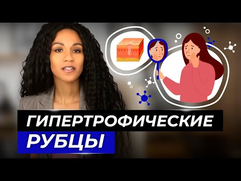 Видео: Рубцы: как избавиться? // Методы борьбы с гипертрофическими рубцами // Гипертрофический рубец