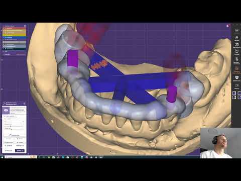 Видео: ExoPlan 3.1 хирургический шаблон при узком гребне
