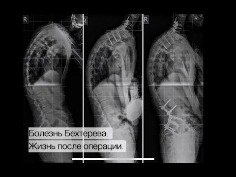 Видео: Болезнь Бехтерева