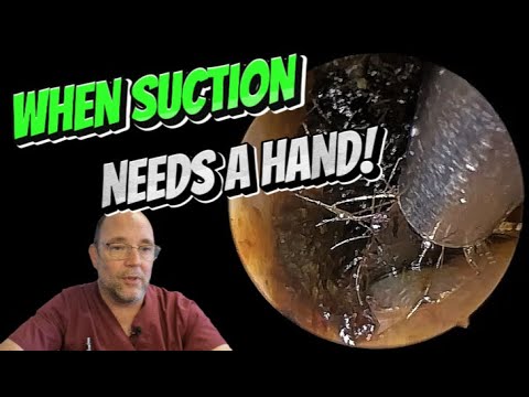 Видео: КОГДА НУЖНА РУКA ДЛЯ ОТСАСЫВАНИЯ! 299 #ухо #ушнаясера #удалениеушнойсеры #fyp #asmr #длявас #удов...