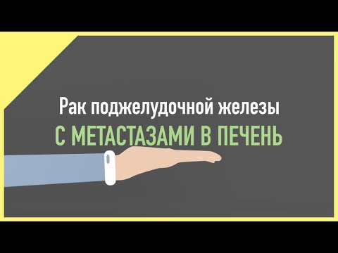 Видео: Клинический пример лечения пациента с раком поджелудочной железы (метастазы в печени)