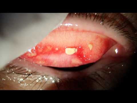 Видео: Удаление глазного камня? Нет, это целая глыба! | Эпизод 30