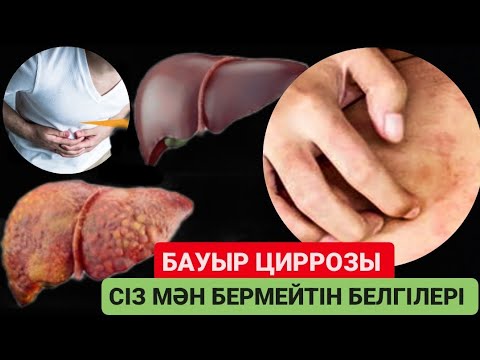 Видео: ЦИРРОЗ. Бауыр циррозы қаншалықты қаупті. Алғашқы белгілері.#казакша