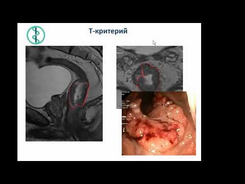 Видео: Гришко П.Ю.«МРТ в диагностике рака прямой кишки»