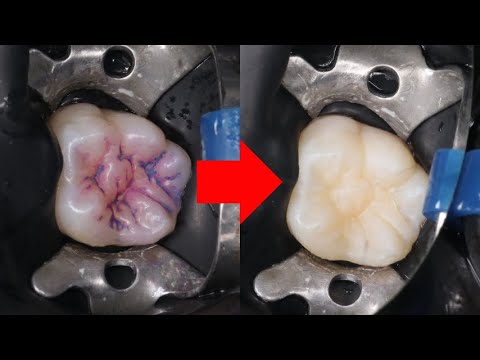 Видео: Лучший способ спасти постоянные зубы ребенка от кариеса