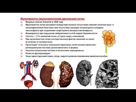 Видео: УЗИ. Доктор Иогансен. Выпуск 72. Аномалии развития почек и мочеточников. Часть 4.