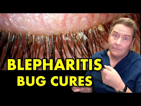 Видео: Что такое блефарит и как его вылечить.... Раз и навсегда.