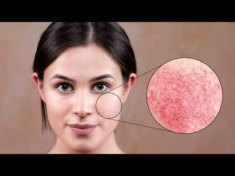 Видео: Купероз: причины, симптомы, способы лечения