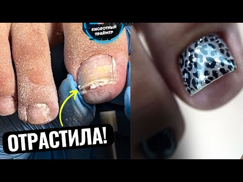 Видео: 2 МЕСЯЦА ПЕДИКЮРУ! СНОВА ПОДНОГТЕВАЯ МОЗОЛЬ и СТЕРЖНЕВАЯ МОЗОЛЬ!