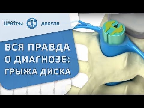 Видео: 🙌 Методика консервативного лечения грыжи межпозвонковых дисков. Лечение межпозвонковой грыжи. 12+