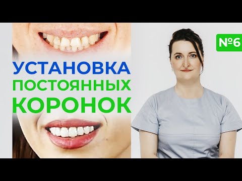 Видео: Протезирование зубов. Установка постоянных коронок / Заключительный этап протезирования
