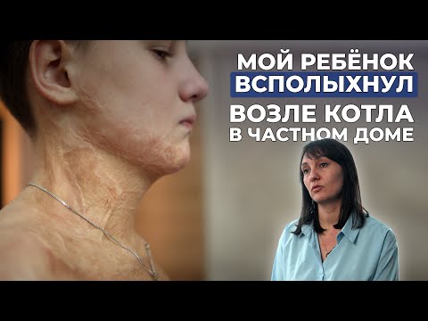 Видео: ОЖОГИ 80 % ПОВЕРХНОСТИ ТЕЛА | История Егора Васильева