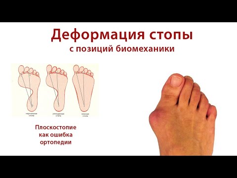 Видео: Ошибка ортопедии