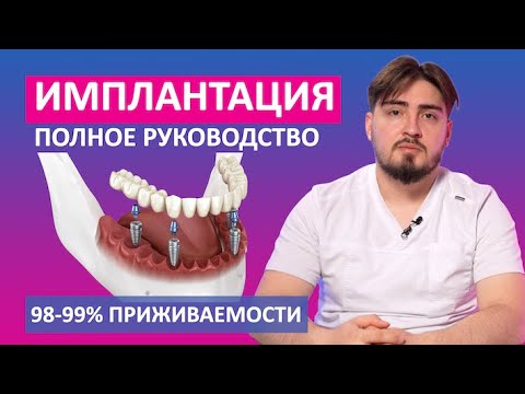 Видео: Зубные импланты - виды, цены, сравнение производителей. Стоимость имплантов для зубов.