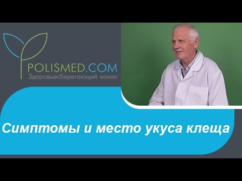 Видео: Симптомы и место укуса клеща. Сколько живет клещ после укуса. К какому врачу обращаться