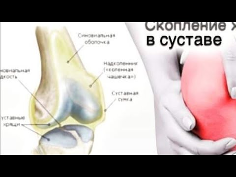 Видео: Гимнастика при бурсите, синовите коленного сустава. Улучшение связи в тканях и связках