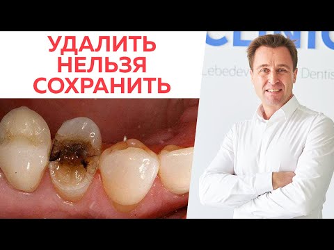 Видео: Удалить зуб или оставить? \ Как решает врач, когда удалить зуб, а когда оставить?