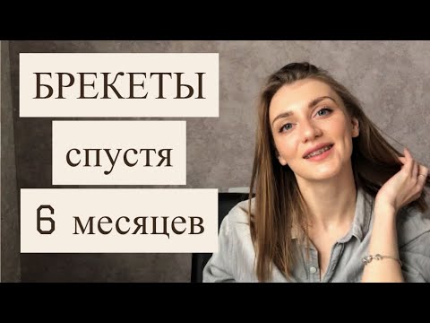 Видео: БРЕКЕТЫ (МЕТАЛЛИЧЕСКИЕ) СПУСТЯ ПОЛГОДА / ФОТО ДО и ПОСЛЕ / ИСПРАВЛЕНИЕ ПРИКУСА