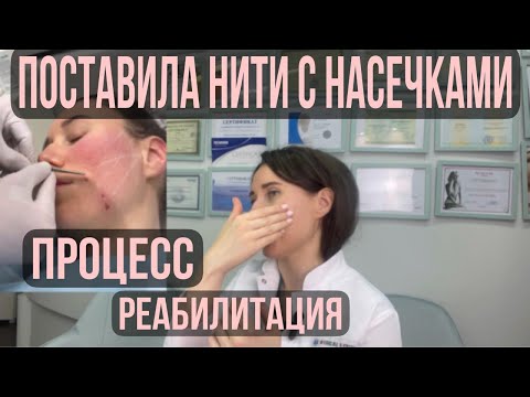 Видео: НИТИ в лицо в 30 лет. Мезонити, полимолочные коги. Врач косметолог про подтяжку лица.