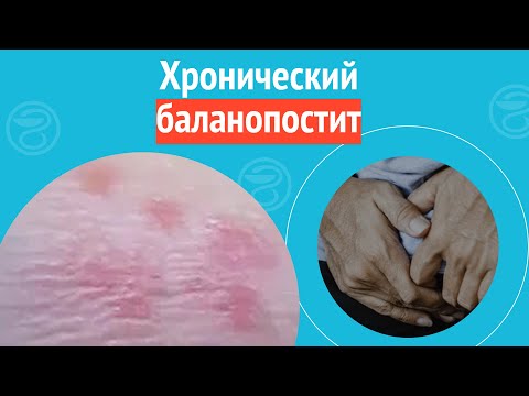 Видео: ➡️ Хронический баланопостит. Клинический случай №1313