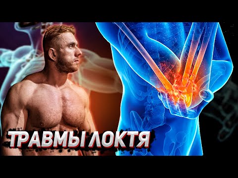Видео: О лечение локтя. Медиальный и латеральный эпикондилит. Повреждения трицепса.