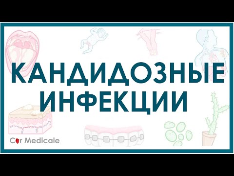 Видео: Кандидозные инфекции - кратко причины, симптомы, диагностика, лечение