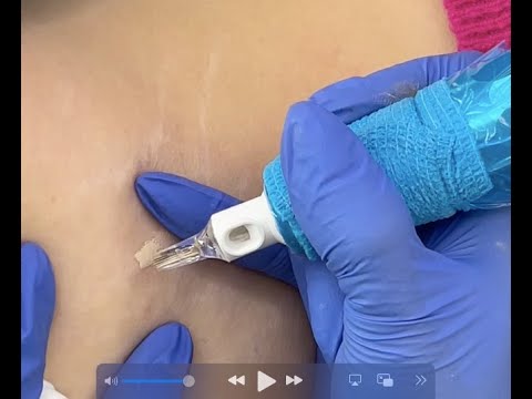 Видео: Посмотрите, как я избавляюсь от растяжек