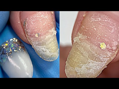 Видео: Клиент отковырял ноготь / 2 месяца ногтям / Коррекция ногтей гелем