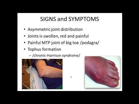 Видео: Тулай өвчин, шалтгаан, эмгэг жам, эмнэлзүй, оношилгоо, эмчилгээ by Tsengel