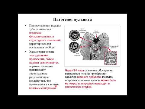 Видео: Эндодонтия 3. Воспаление пульпы. Этиология, патогенез, классификация