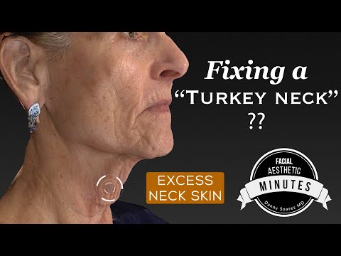 Видео: Подтяжка шеи «индюшачья шея» (72 года) — подтяжка шеи | Aesthetic Minutes #Necklift