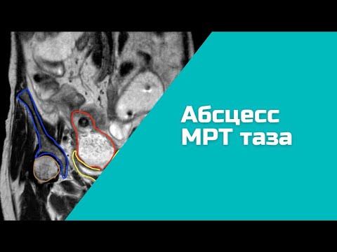 Видео: Болезнь Крона ? (ждём ответа от хирургов), абсцесс МРТ (ПОДРОБНЫЙ РАЗБОР).