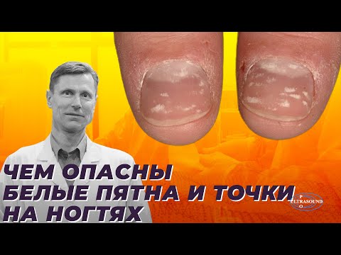 Видео: Чем опасны белые пятна и точки на ногтях.