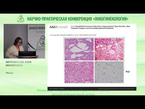 Видео: Мелкоклеточная карцинома яичника, гиперкальциемический тип