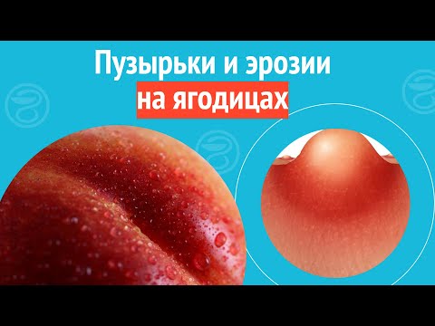 Видео: 😦 Пузырьки и эрозии на ягодицах. Клинический случай №1087